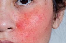 Image result for Common Skin Blemishes