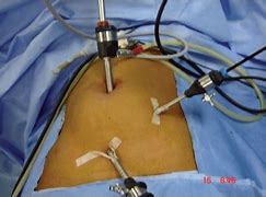 Image result for Laparoscopic Port Placement