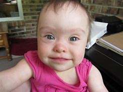 Image result for Down Syndrome