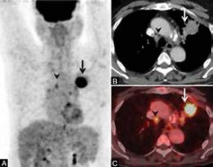 Image result for Pet Scan Lung Cancer Stage 4