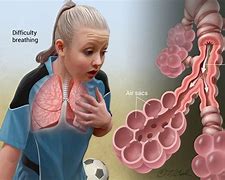 Image result for Acute Asthma Attack