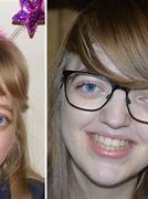 Image result for Crouzon Syndrome Before and After