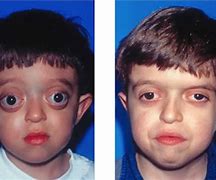 Image result for Crouzon Syndrome Adult