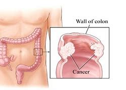 Image result for Stage 4 Colon Cancer Prognosis