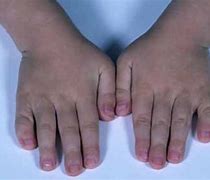 Image result for Characteristics of Klinefelter%27s Syndrome