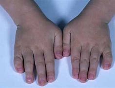 Image result for How Common Is Klinefelter Syndrome
