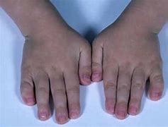 Image result for Klinefelter Syndrome Real Example