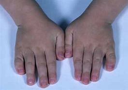 Image result for Klinefelter Syndrome in Adults