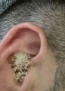 Image result for Ear Clogged Wax