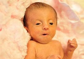 Image result for Pictures Babies Edwards Disease