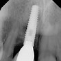 Image result for Dental Implant Tooth