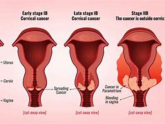 Image result for Stage 4 Cervical Cancer