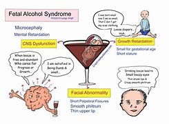 Image result for Features of Fetal Alcohol Syndrome