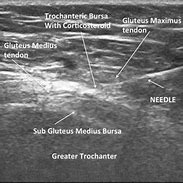 Image result for Greater Trochanter Injection