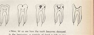 Image result for Tooth Decay Problem