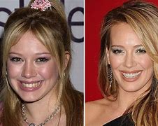Image result for Hilary Duff Veneers Before and After
