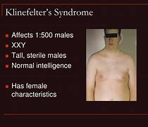 Image result for Klinefelter%27s Syndrome