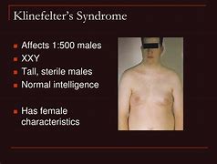 Image result for Klinefelter's Syndrome Percentage