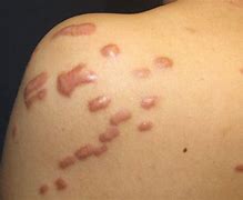 Image result for What Are Keloid Scars