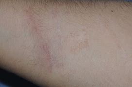 Image result for Scars On Arms