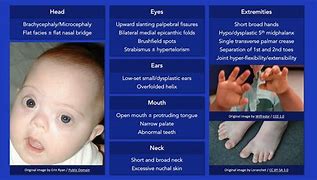 Image result for Dysmorphic Features