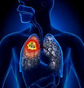 Image result for Stage 3A Lung Cancer