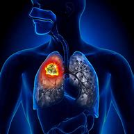 Image result for Lung Cancer