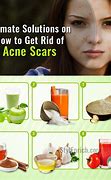Image result for Get Rid of Acne Scars