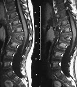 Image result for Hurler Syndrome Spine