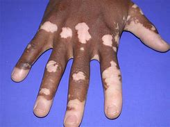 Image result for Problem Skin Conditions