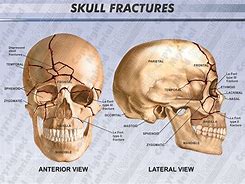 Image result for Skull Base Fracture