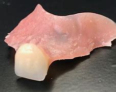 Image result for Temporary Tooth Flipper