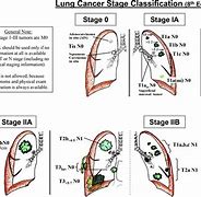 Image result for Early Stage Lung Cancer Prognosis