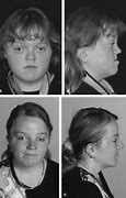 Image result for Pfeiffer Syndrome