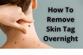 Image result for How to Remove Skin Tag On Anis