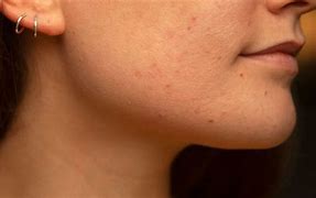 Image result for Little Acne