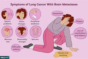 Image result for Stage 4 Metastatic Melanoma Brain Cancer