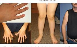 Image result for XXY Syndrome in Boys