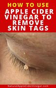Image result for Skin Tag in Corner of Eye