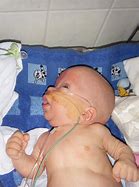 Image result for Costello Syndrome