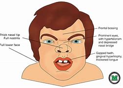 Image result for Dysmorphic Features