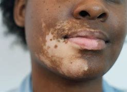 Image result for Uneven Skin Tone