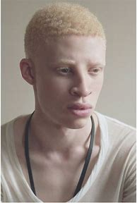 Image result for Albino African American Male