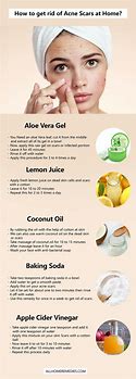 Image result for How to Get Rid of Acne Marks