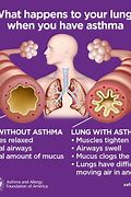 Image result for Pathophysiology of Asthma in Adults