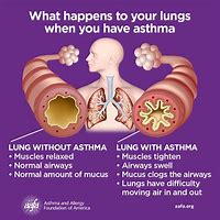 Image result for Asthma Facts