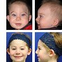 Image result for Crouzon Syndrome Bicoronal Craniosynostosis