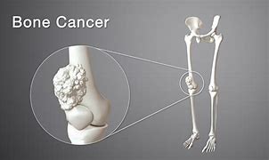 Image result for Stage 4 Metastatic Bone Cancer