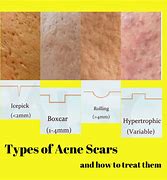 Image result for Acne Scars Craters