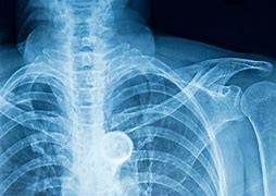 Image result for Bruised Ribs